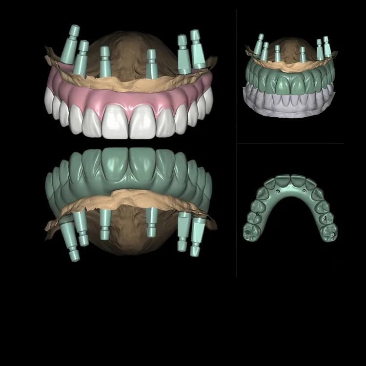 Implant CAD & Guided Planning