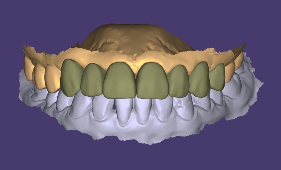Milling Files & Aligner Manufacturing