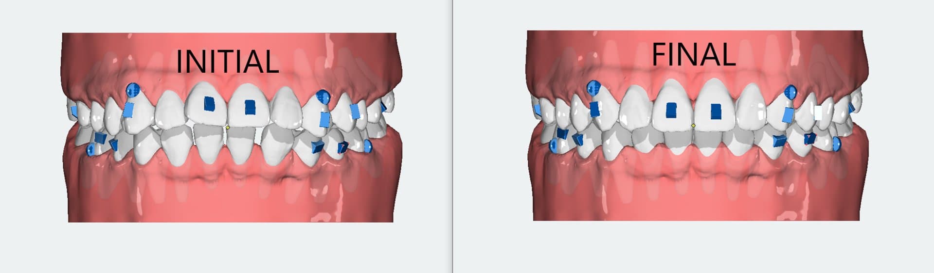 Clear aligner setup — initial vs final comparison