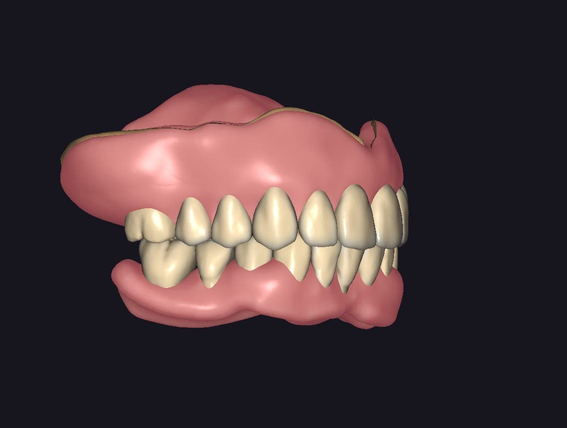 Complete Denture Design