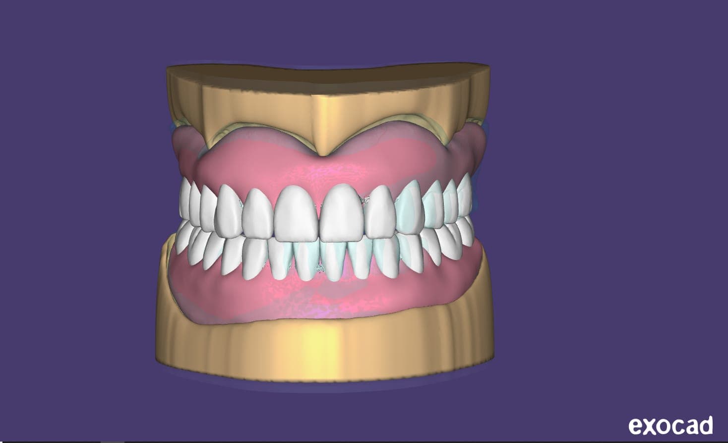 Denture & Removable CAD