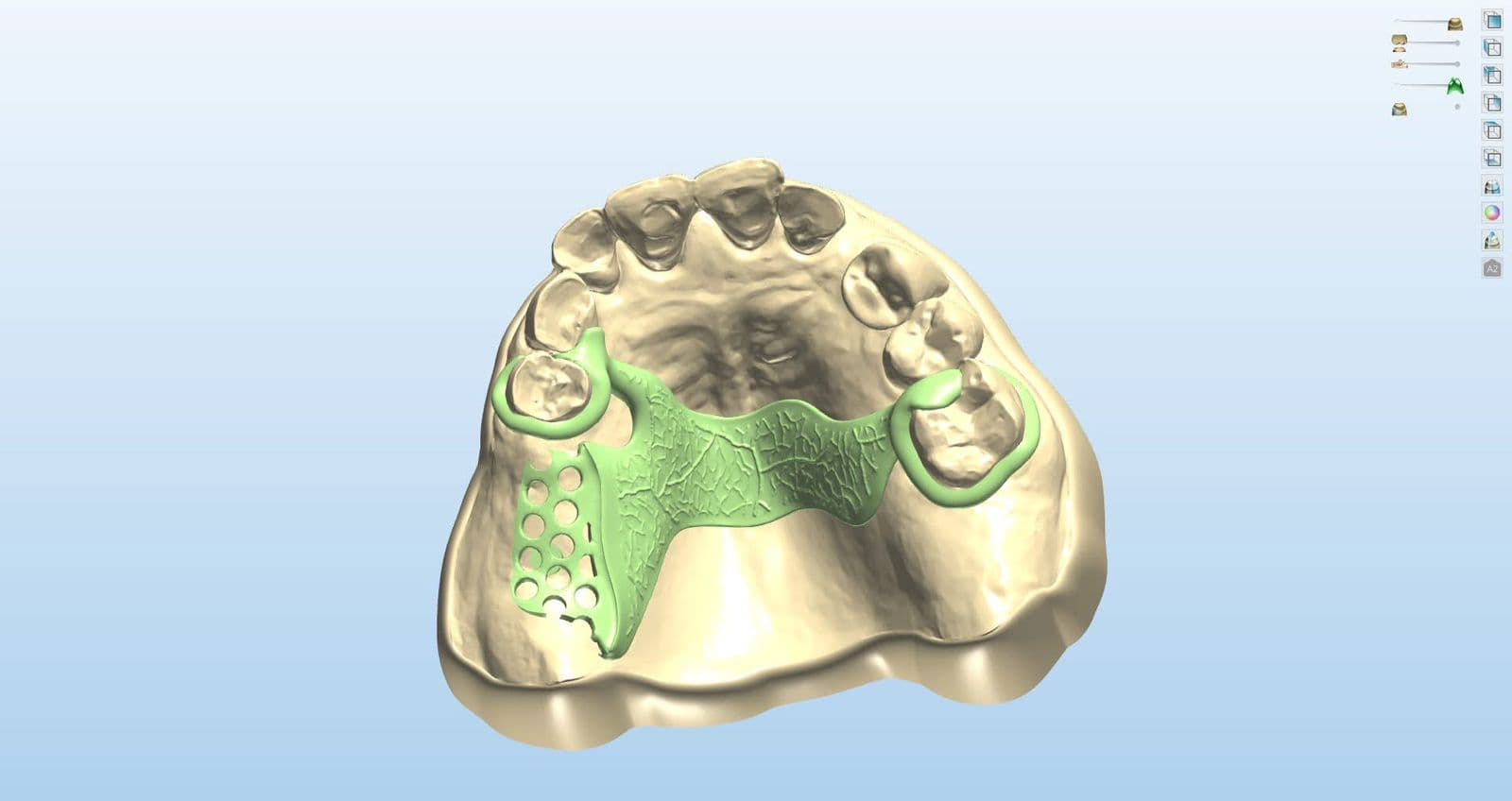 Partial Denture Framework