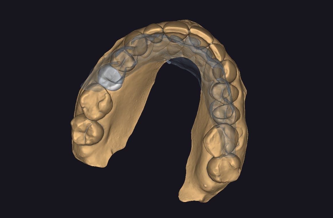 Posterior Crown Design