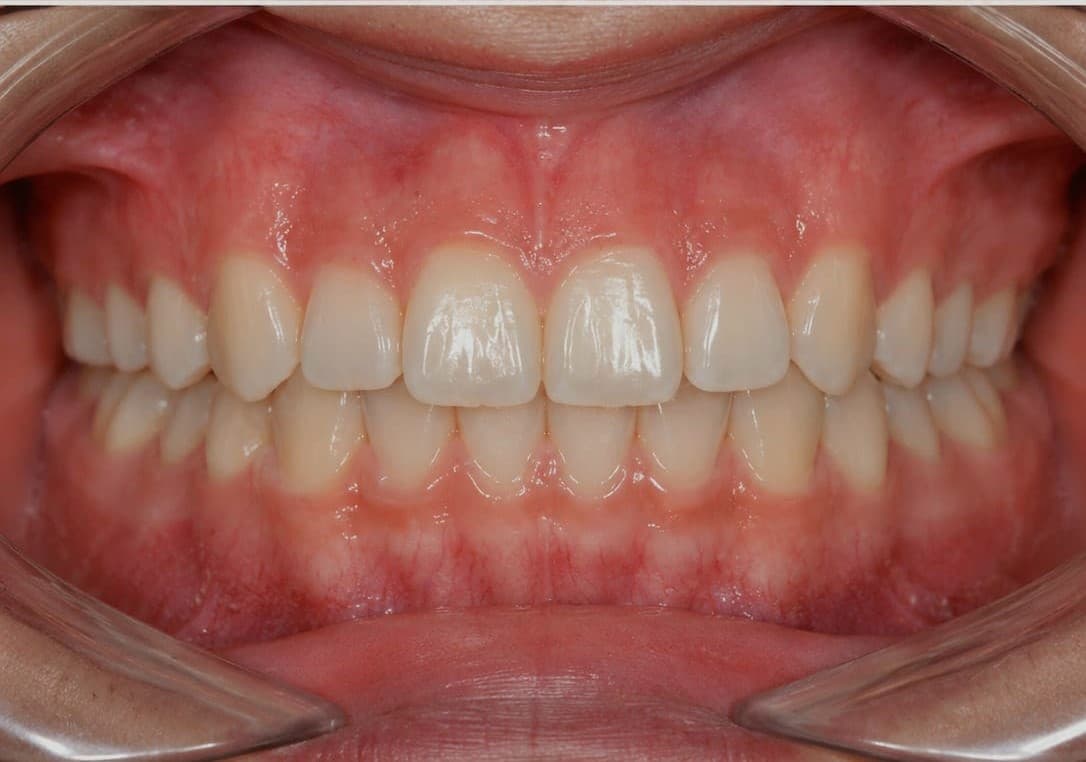 Clear aligner case 1 — after treatment, teeth aligned
