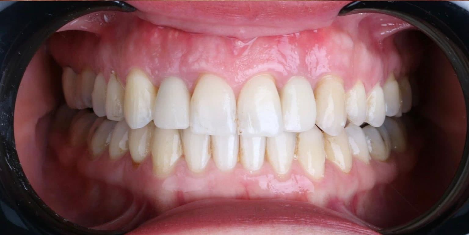 Clear aligner case 3 — after treatment, spacing closed