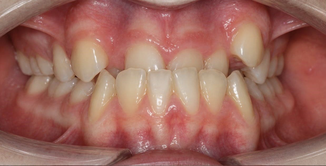 Clear aligner case 2 — before treatment