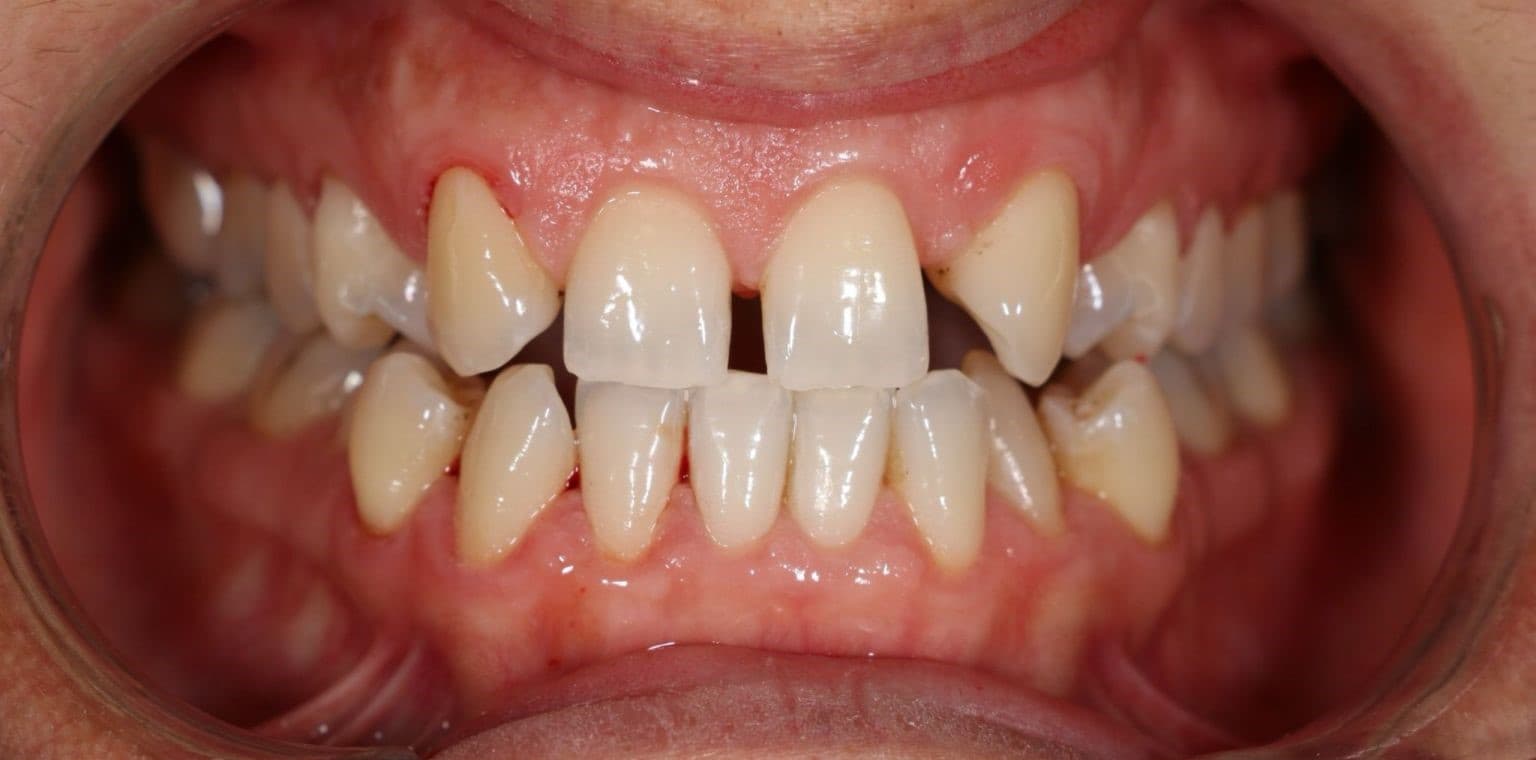 Clear aligner case 3 — before treatment