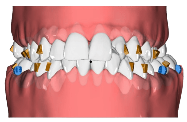 Crossbite — initial tooth positions
